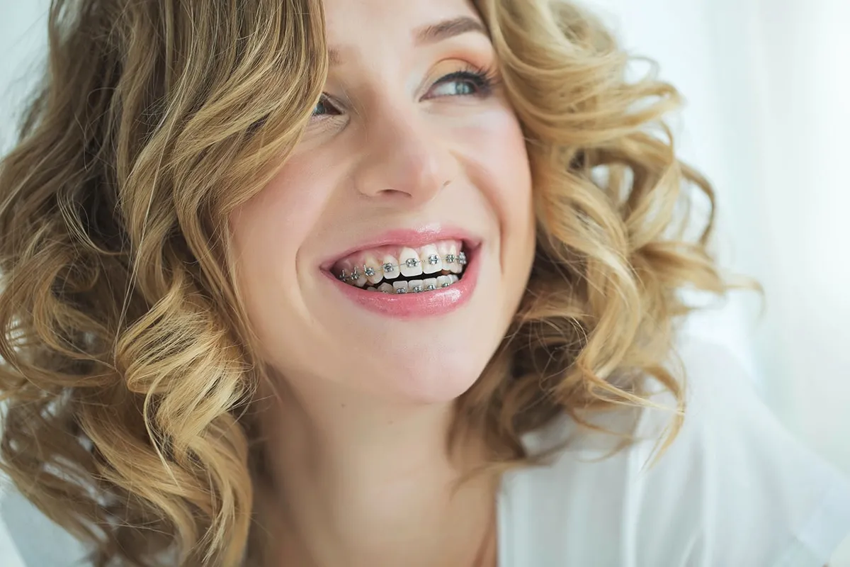 Types of Braces for Adults in Pearland, TX