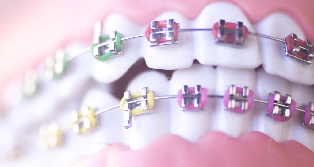 Orthodontic Rubber Bands in Spring, League City, & Cypress, TX