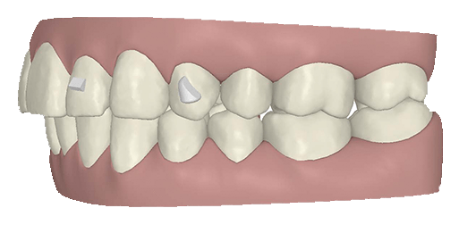 Teeth - bumps