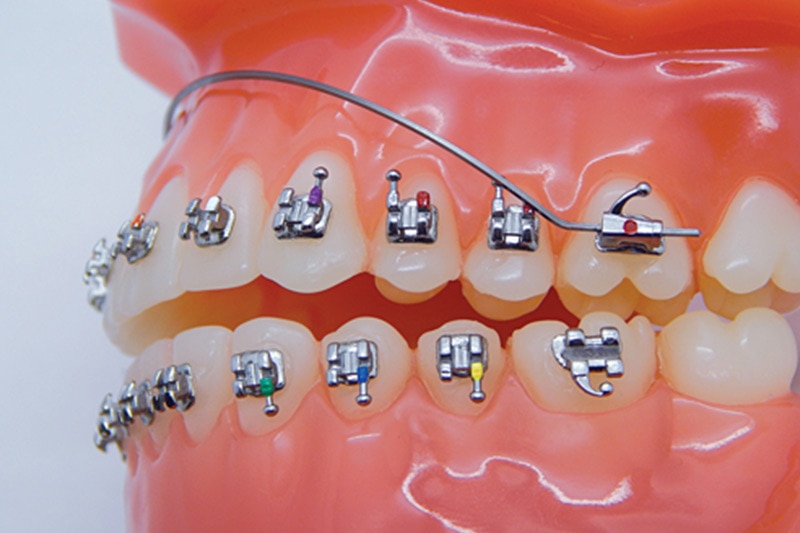 Orthodontic Rubber Bands in Spring, League City, & Cypress, TX