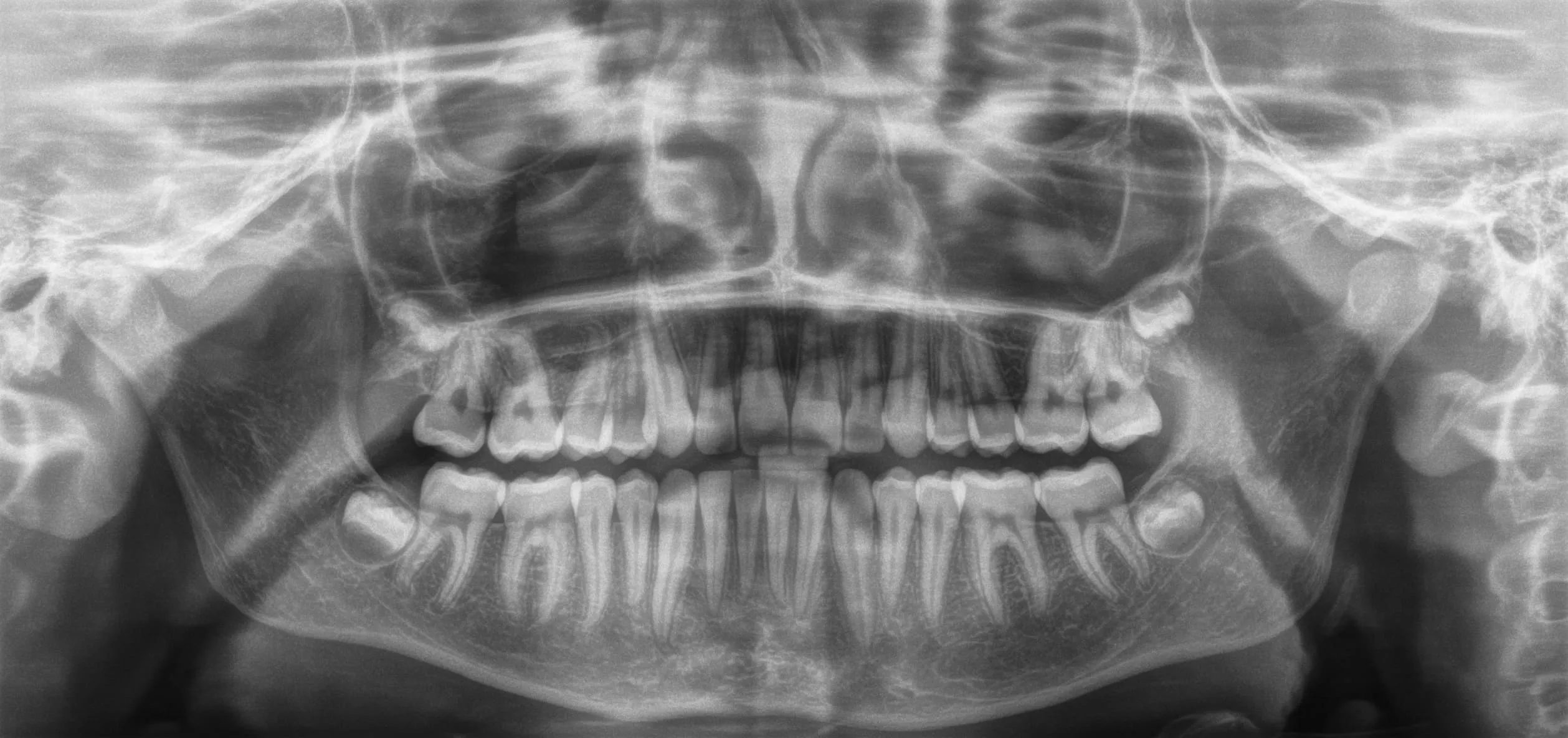 Panoramic radiograph showing both jaws, teeth, maxillary sinuses, and parts of the neck, used for orthodontic evaluation at AvA Orthodontics.